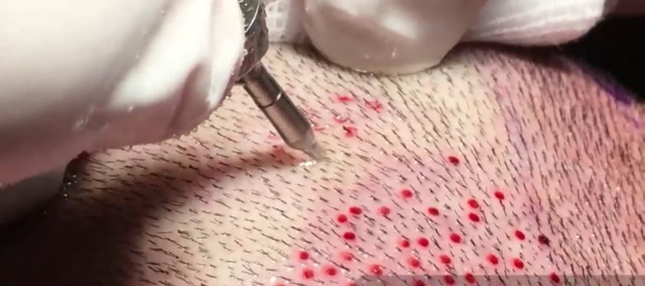 Hair Transplant UK: Trusted Experts at Westminster Medical Group®
