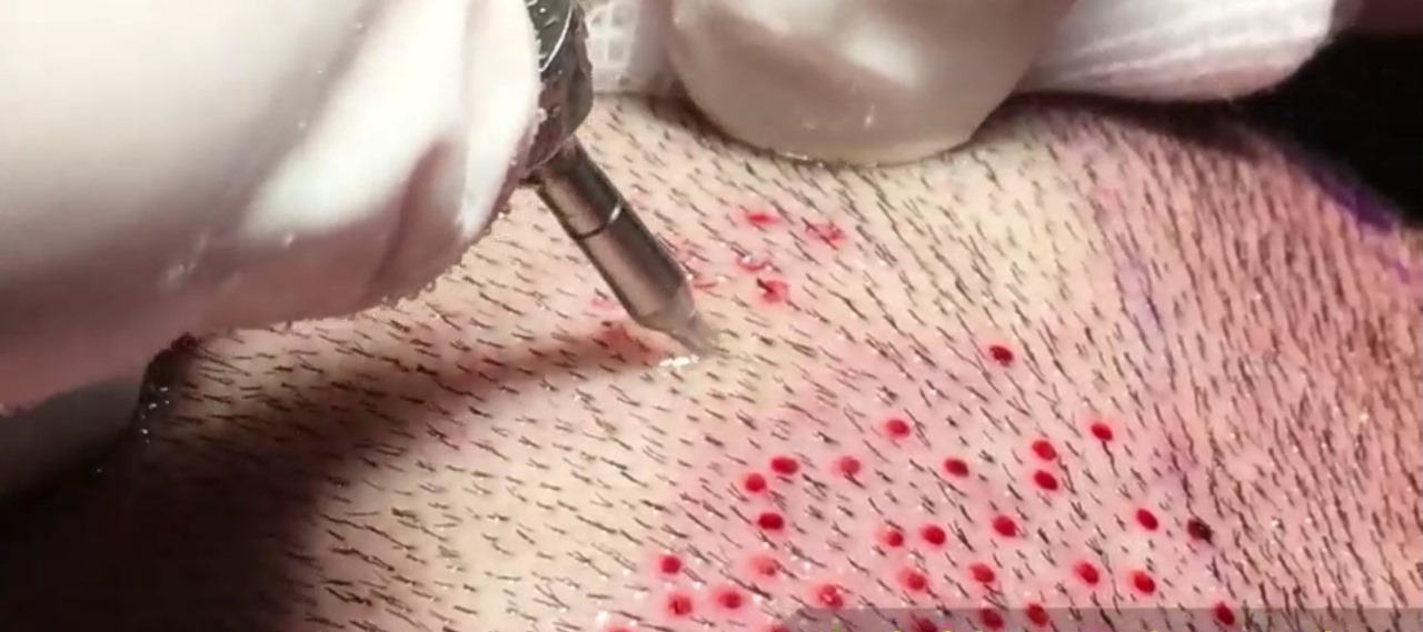 Hair Transplant UK: Trusted Experts at Westminster Medical Group®