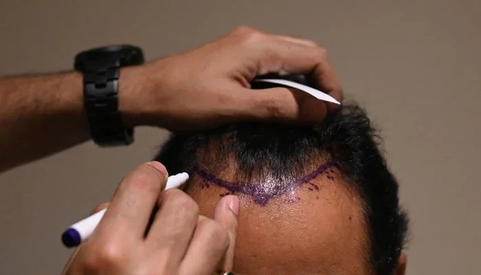 Hair Transplant Istanbul: Trusted Clinics for Permanent Solutions