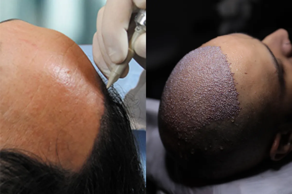 Leading Hair Transplant UK Specialists at Westminster Medical Group