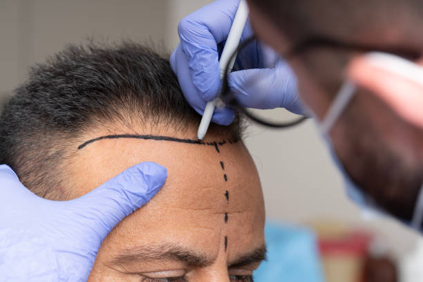 How Much Is Hair Transplant with FUE Method?