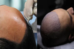 artificial-hair-transplant-vs-real-hair-transplant-1